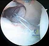 صورة توضيحية لـ إصلاح عدم استقرار الكتف الخلفي بالمنظار: دليل شامل للمرضى مع الأستاذ الدكتور محمد هطيف بصنعاء