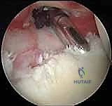 صورة توضيحية لـ إصلاح عدم استقرار الكتف الخلفي بالمنظار: دليل شامل للمرضى مع الأستاذ الدكتور محمد هطيف بصنعاء