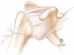 تضرر الشفا الحقاني في حالات الخلع