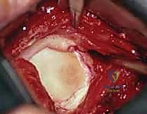 مقارنة بين الكتف السليم والكتف المصاب بالخلع المزمن