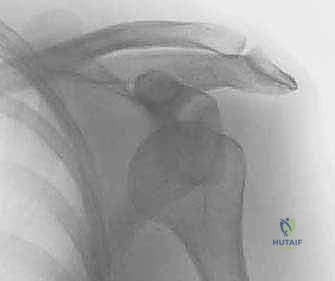 عدم استقرار الكتف الأمامي: دليل شامل لإصلاح بانكارت وتثبيت المحفظة السفلية مع الأستاذ الدكتور محمد هطيف