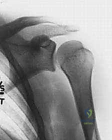 صورة أشعة سينية توضح خلع الكتف الأمامي