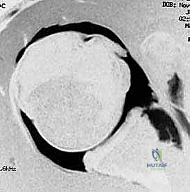 فحص الكتف السريري لعدم الاستقرار الأمامي