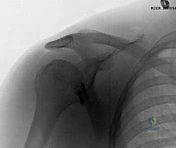 إصابات الملاعب وتأثيرها على الكتف