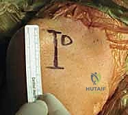 تأثير الحركات المتكررة على مفصل الكتف