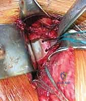 صورة توضيحية لـ عدم استقرار الكتف الأمامي: دليل شامل لإصلاح بانكارت وتثبيت المحفظة السفلية مع الأستاذ الدكتور محمد هطيف