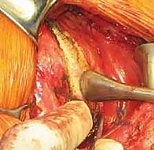 تنظيف وتحضير العظم الحقاني