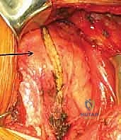 استخدام تقنية المنظار 4K في جراحة الكتف