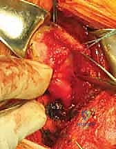 زراعة الخطاطيف العظمية الدقيقة