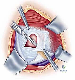 الفحص النهائي بالمنظار لثبات المفصل