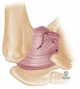 مريض يرتدي حمالة الكتف الداعمة