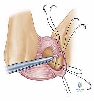 صورة توضيحية لـ عدم استقرار الكتف الأمامي: دليل شامل لإصلاح بانكارت وتثبيت المحفظة السفلية مع الأستاذ الدكتور محمد هطيف