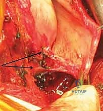 إغلاق الشقوق الجراحية بغرز تجميلية