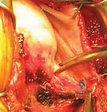 صورة توضيحية لـ عدم استقرار الكتف الأمامي: دليل شامل لإصلاح بانكارت وتثبيت المحفظة السفلية مع الأستاذ الدكتور محمد هطيف