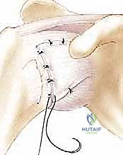 بدء جلسات العلاج الطبيعي بعد الجراحة