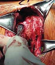 Illustration of inferior capsular shift - Dr. Mohammed Hutaif