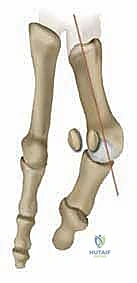 صورة توضيحية لـ جراحة ورم إبهام القدم الأروح المتقدم: تقنية شفرون ثنائية المستوى مع الأستاذ الدكتور محمد هطيف
