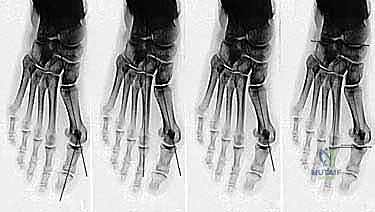 جراحة ورم إبهام القدم الأروح المتقدم: تقنية شفرون ثنائية المستوى مع الأستاذ الدكتور محمد هطيف