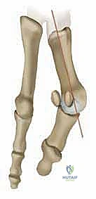صورة توضيحية لـ جراحة ورم إبهام القدم الأروح المتقدم: تقنية شفرون ثنائية المستوى مع الأستاذ الدكتور محمد هطيف