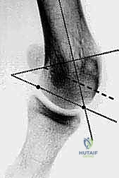صورة توضيحية لـ جراحة ورم إبهام القدم الأروح المتقدم: تقنية شفرون ثنائية المستوى مع الأستاذ الدكتور محمد هطيف