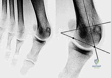 صورة طبية: جراحة ورم إبهام القدم الأروح المتقدم: تقنية شفرون ثنائية المستوى مع الأستاذ الدكتور محمد هطيف
