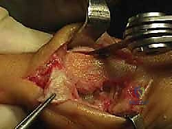 صورة طبية: جراحة ورم إبهام القدم الأروح المتقدم: تقنية شفرون ثنائية المستوى مع الأستاذ الدكتور محمد هطيف