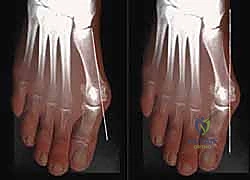 صورة طبية: جراحة ورم إبهام القدم الأروح المتقدم: تقنية شفرون ثنائية المستوى مع الأستاذ الدكتور محمد هطيف