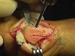 صورة توضيحية لـ جراحة ورم إبهام القدم الأروح المتقدم: تقنية شفرون ثنائية المستوى مع الأستاذ الدكتور محمد هطيف