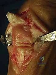 تحديد زوايا القطع العظمي