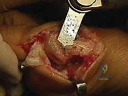 صورة طبية: جراحة ورم إبهام القدم الأروح المتقدم: تقنية شفرون ثنائية المستوى مع الأستاذ الدكتور محمد هطيف