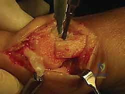 صورة طبية: جراحة ورم إبهام القدم الأروح المتقدم: تقنية شفرون ثنائية المستوى مع الأستاذ الدكتور محمد هطيف