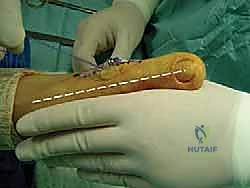 تثبيت العظم أثناء العملية