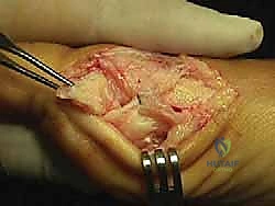 صورة طبية: جراحة ورم إبهام القدم الأروح المتقدم: تقنية شفرون ثنائية المستوى مع الأستاذ الدكتور محمد هطيف