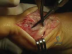 صورة طبية: جراحة ورم إبهام القدم الأروح المتقدم: تقنية شفرون ثنائية المستوى مع الأستاذ الدكتور محمد هطيف