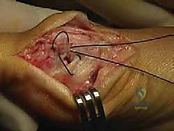 صورة طبية: جراحة ورم إبهام القدم الأروح المتقدم: تقنية شفرون ثنائية المستوى مع الأستاذ الدكتور محمد هطيف