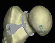 أشعة سينية توضح التآكل