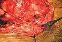 بدء العلاج الطبيعي في المستشفى