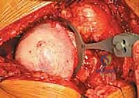 صورة طبية: استبدال سطح مفصل الورك: حل متطور لآلام الورك واستعادة النشاط مع الأستاذ الدكتور محمد هطيف