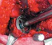 كشف كبسولة المفصل