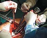 صورة طبية: استبدال سطح مفصل الورك: حل متطور لآلام الورك واستعادة النشاط مع الأستاذ الدكتور محمد هطيف