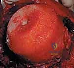 استبدال سطح مفصل الورك: حل متطور لآلام الورك واستعادة النشاط مع الأستاذ الدكتور محمد هطيف