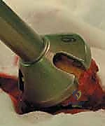 صورة توضيحية لـ استبدال سطح مفصل الورك: حل متطور لآلام الورك واستعادة النشاط مع الأستاذ الدكتور محمد هطيف