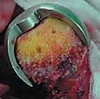 صورة طبية: استبدال سطح مفصل الورك: حل متطور لآلام الورك واستعادة النشاط مع الأستاذ الدكتور محمد هطيف