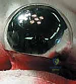 بدء الشق الجراحي