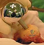 صورة طبية: استبدال سطح مفصل الورك: حل متطور لآلام الورك واستعادة النشاط مع الأستاذ الدكتور محمد هطيف