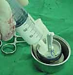 استخدام الأسمنت الطبي للتثبيت