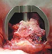صورة توضيحية لـ استبدال سطح مفصل الورك: حل متطور لآلام الورك واستعادة النشاط مع الأستاذ الدكتور محمد هطيف