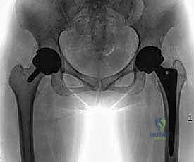 صورة طبية: استبدال سطح مفصل الورك: حل متطور لآلام الورك واستعادة النشاط مع الأستاذ الدكتور محمد هطيف