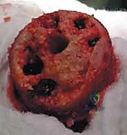 صورة طبية: استبدال سطح مفصل الورك: حل متطور لآلام الورك واستعادة النشاط مع الأستاذ الدكتور محمد هطيف