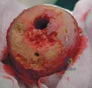 صورة طبية: استبدال سطح مفصل الورك: حل متطور لآلام الورك واستعادة النشاط مع الأستاذ الدكتور محمد هطيف